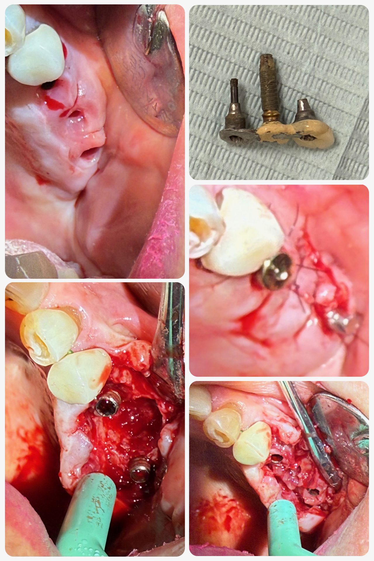 Clinical intraoral view of splinted implant-supported FDP #13–15