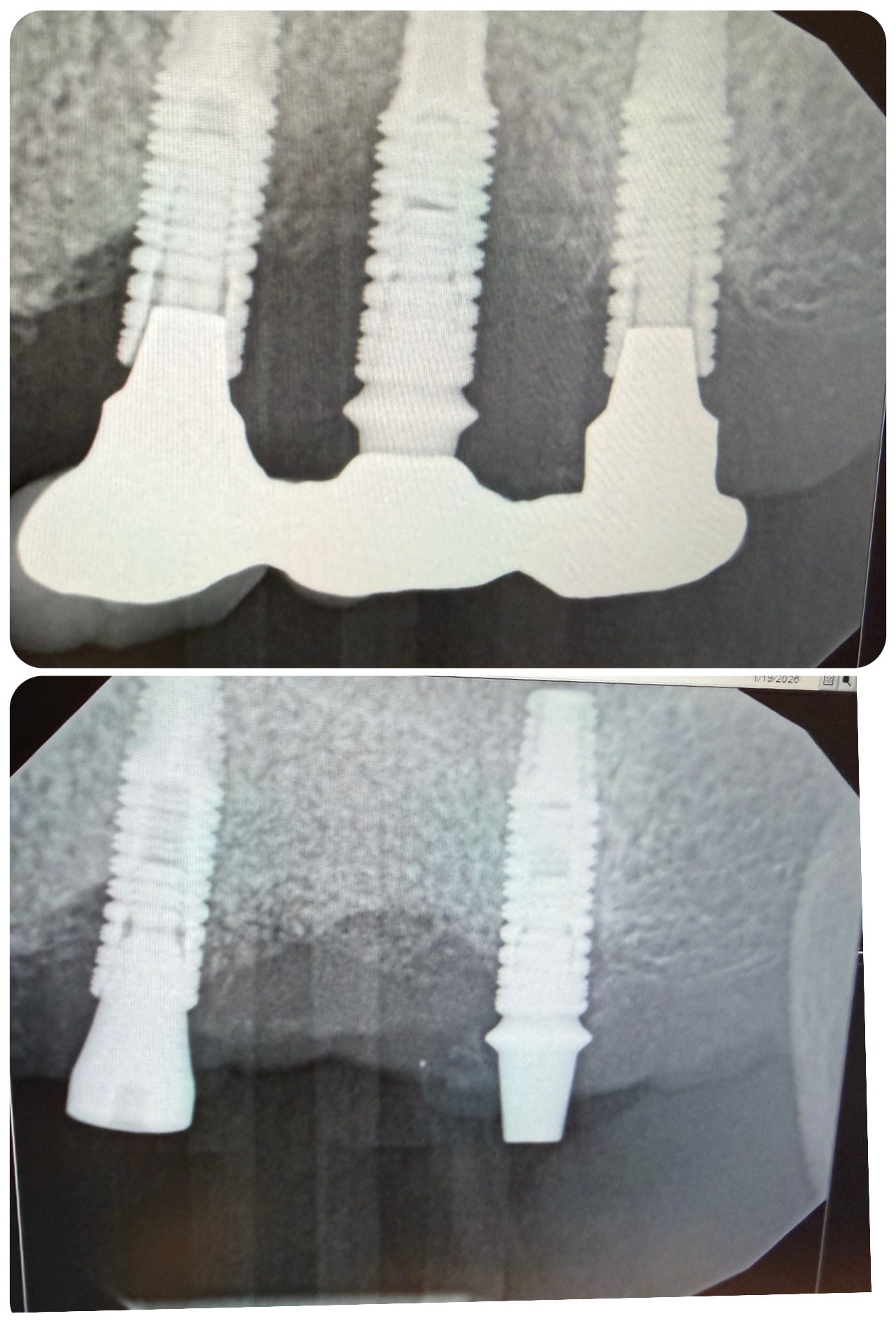 Radiographic view showing bone loss around middle implant #14